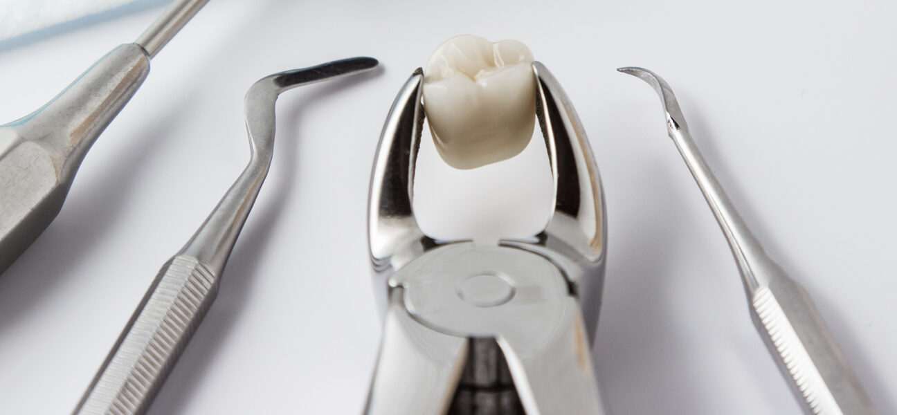 Why Is It Important to Remove Wisdom Teeth? Understanding the Risks of Retaining Them