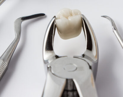 Why Is It Important to Remove Wisdom Teeth? Understanding the Risks of Retaining Them 