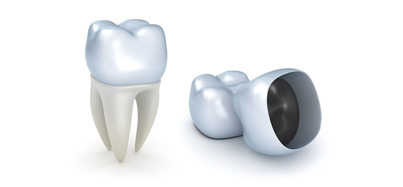 Top 5 Benefits of Dental Crowns for a Healthier Smile
