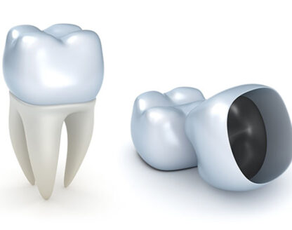 Top 5 Benefits of Dental Crowns for a Healthier Smile 