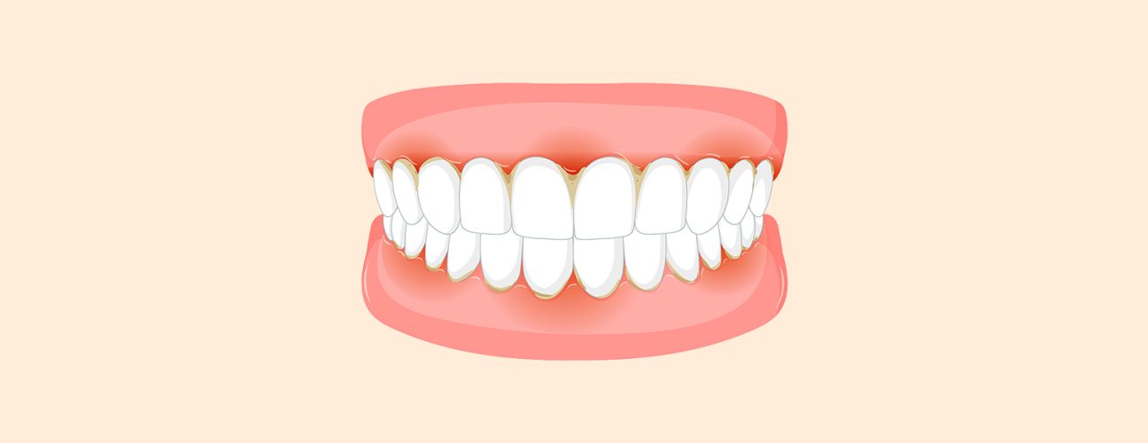 Why Are My Gums Inflamed Even Though I Brush Every Day?