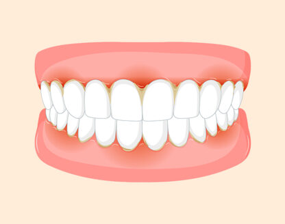 Why Are My Gums Inflamed Even Though I Brush Every Day? 