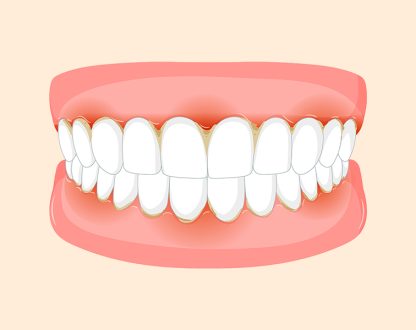 Why Are My Gums Inflamed Even Though I Brush Every Day?
