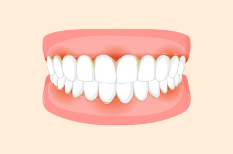 Why Are My Gums Inflamed Even Though I Brush Every Day? 