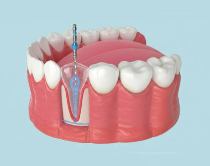 When Does Tooth Pain Signal the Need for a Root Canal? 