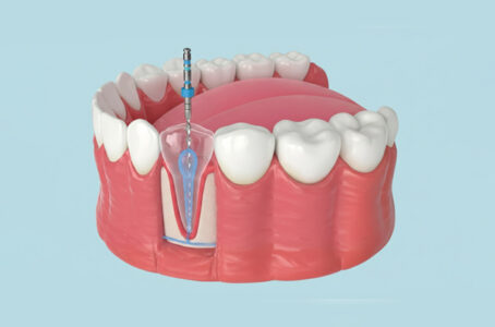 When Does Tooth Pain Signal the Need for a Root Canal? 