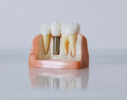 How-Do-Implants-Compare-to-Dentures-or-Bridges 