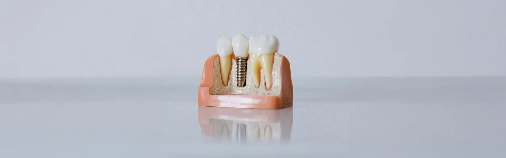 How-Do-Implants-Compare-to-Dentures-or-Bridges